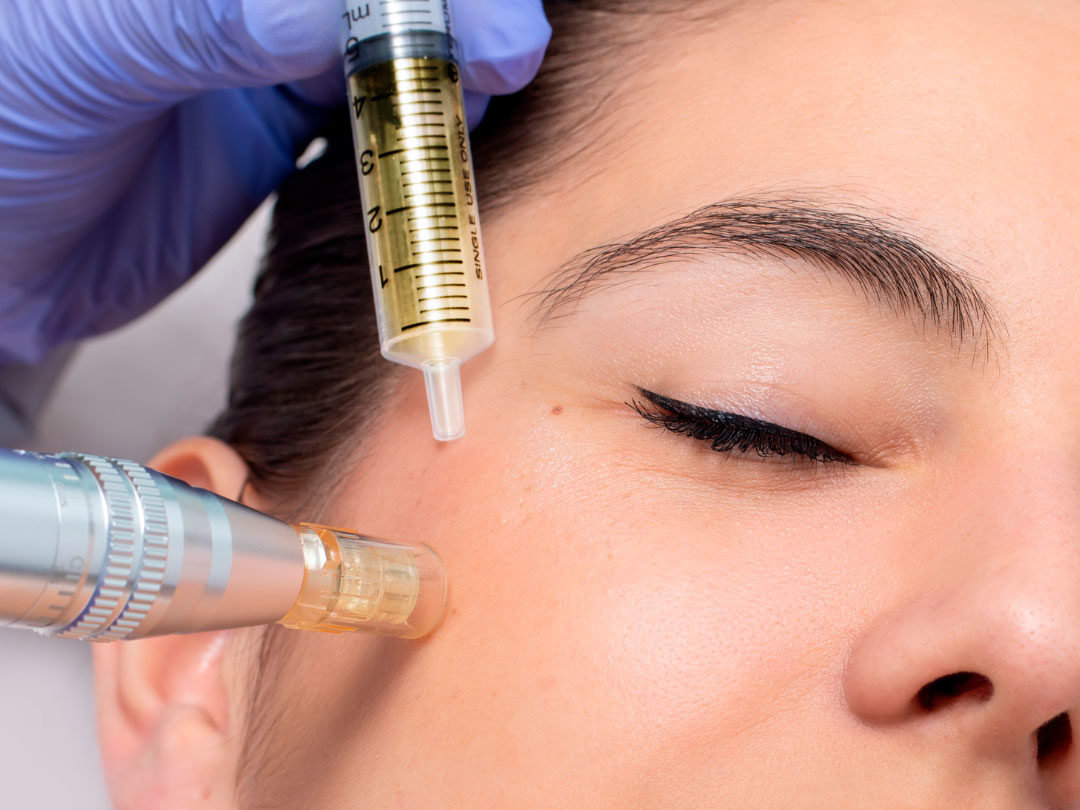 Dermapen Exosomas